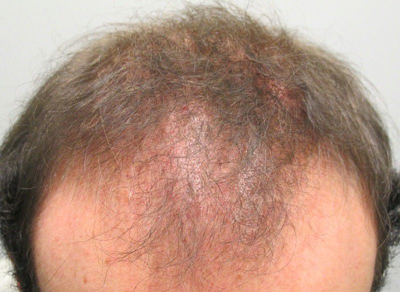 Alopecia