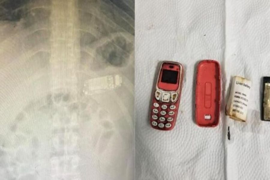 Hombre se tragó un celular Nokia y tuvo que ser operado de urgencia