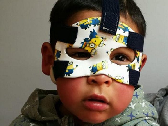 Niños sanan de sus quemaduras con alegres máscaras especiales