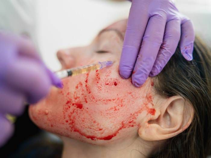 "Vampire facial": popular tratamiento de belleza habría contagiado con VIH a clientas