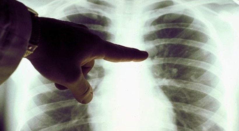 Seremi de Valparaíso descarta brote de tuberculosis en colegio de Viña del Mar: solo un alumno está contagiado