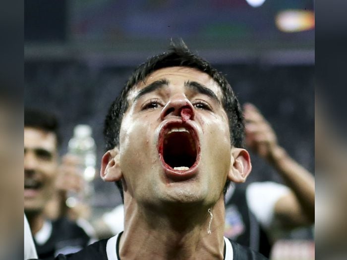 Julio Barroso será baja en Colo Colo por fractura nasal